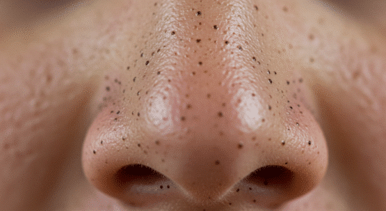 كيف نعالج الرؤوس السوداء