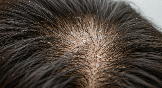 كيف تتخلصى من القشره